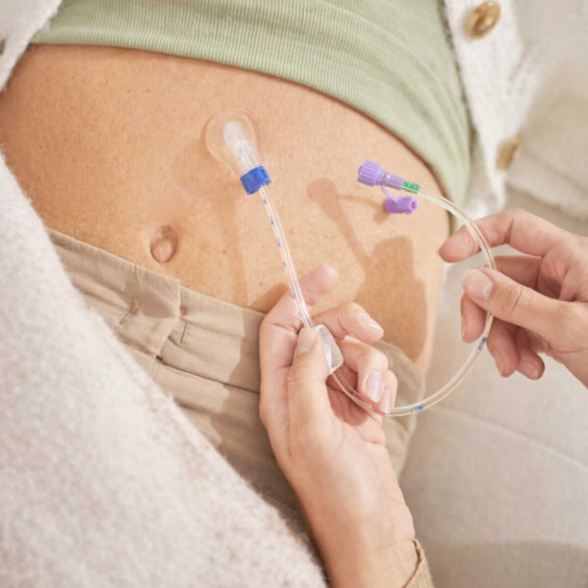 PEG-sonde en sondevoeding in de dagelijkse praktijk
